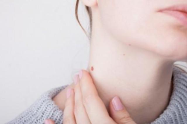 Mole Removal for Dark Skin Tones: What to Know